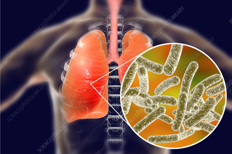 Legionnaires’ Disease – GPs