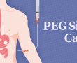 Percutaneous Endoscopic Gastrostomy (PEG) Feeding – GPs