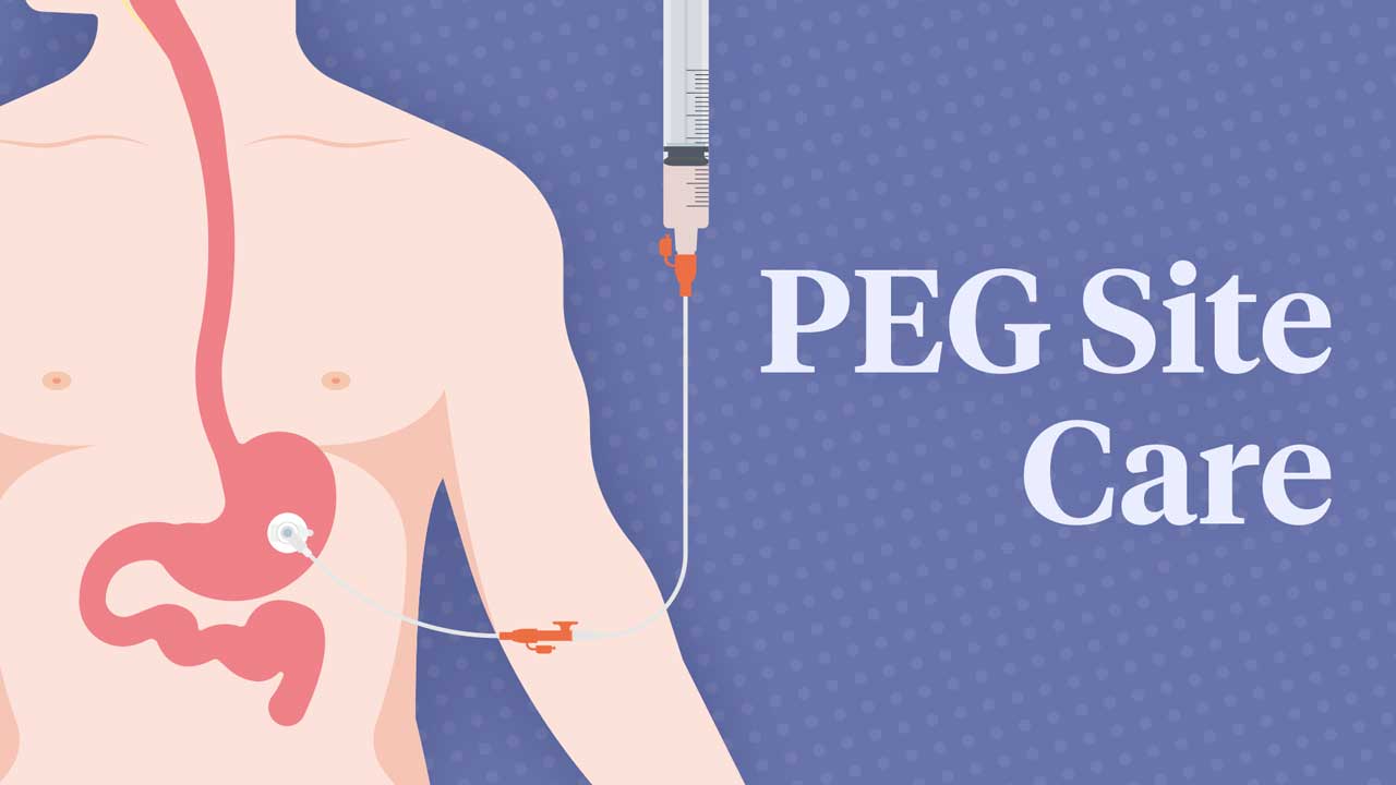 Percutaneous Endoscopic Gastrostomy (PEG) Feeding – GPs